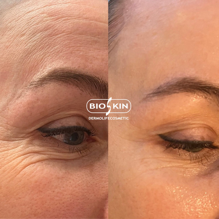 مزو کوکتل بایو اسکین رویتالیفت پرو ۲۰ Bioskin Revitalift pro جوانسازی آبرسانی لیفتینگ